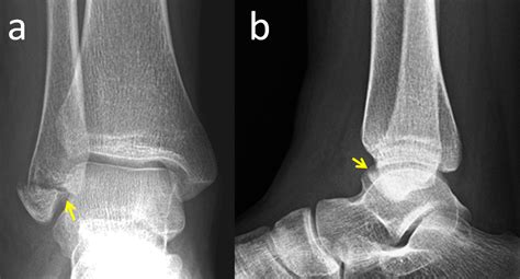 Lateral malleolus fracture picture - wheelswery