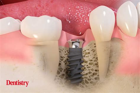 Tissue level implants – what are the benefits? - Dentistry