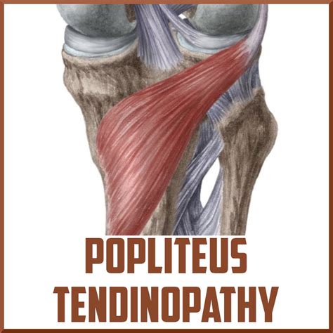 Popliteus Tendinopathy