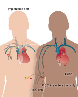 Caring for Your Catheter | CDCF PCI