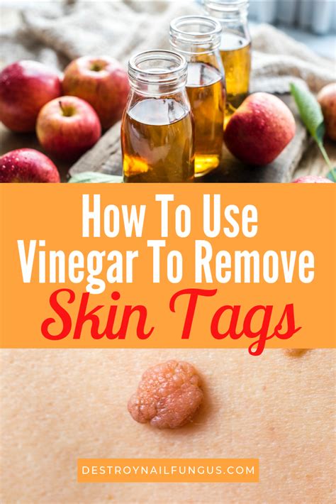 How To Use Apple Cider Vinegar To Remove Skin Tags