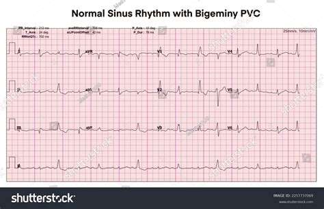 심전도는 중식성 PVC.하트비트를 가진 정상 시누스 스톡 일러스트 2257737069 | Shutterstock