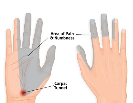Carpal Tunnel Syndrome | Symptoms & Treatment | Total Ortho Center