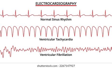 1,152 Ventricular Tachycardia Images, Stock Photos, 3D objects ...