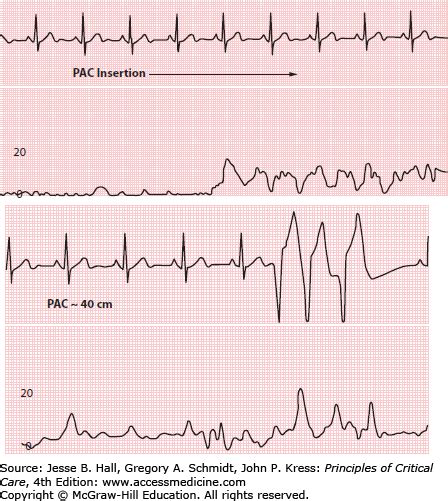 Interpretation of Hemodynamic Waveforms | Anesthesia Key