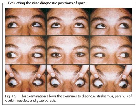 Ophthalmic Examination: Ocular Motility