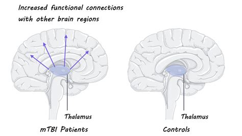 Functional Connections From the Thalamus Can Predict Concussive Symptoms After a Mild Traumatic ...