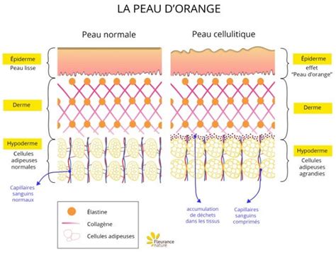 Tout savoir sur la peau d'orange