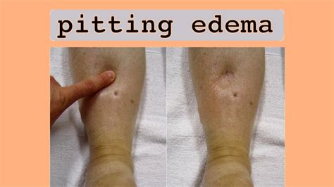 Pitting Edema