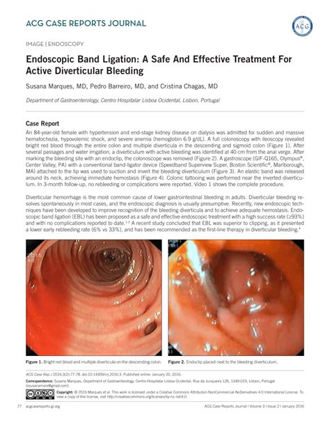 (PDF) Endoscopic Band Ligation: A Safe And Effective Treatment For ...