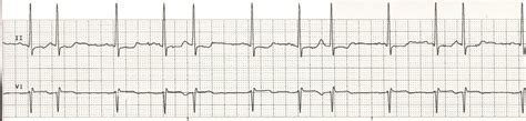 Supraventricular ectopic beat - CardiacMonitoring.com