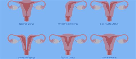 Uterine Abnormalities | Total Fertility