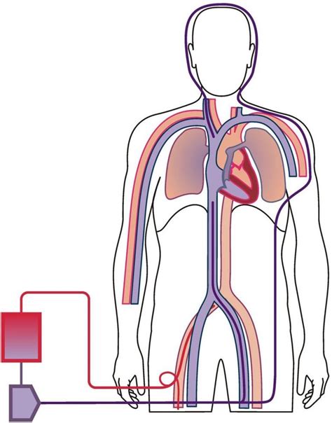 Configurations of ECMO – Alfred ECMO Guideline