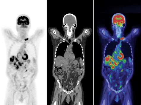 PET-CT Scan - Parkside Hospital