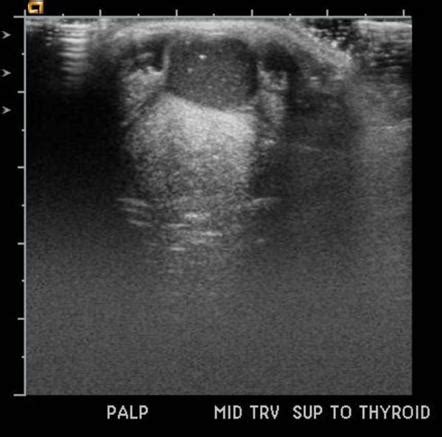 Thyroglossal Duct Cyst Ultrasound Images