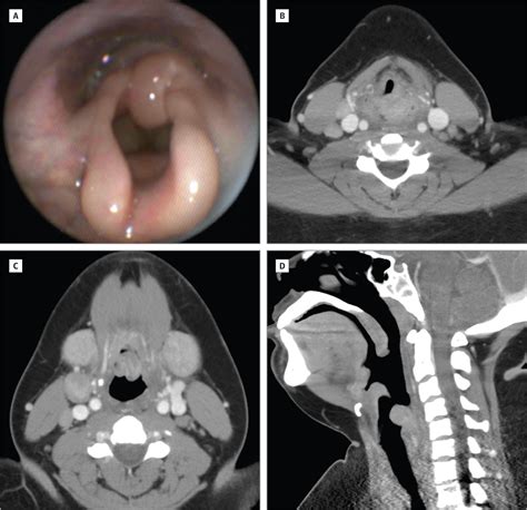 Laryngeal Swelling | Laryngology | JAMA Otolaryngology–Head & Neck ...