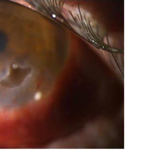 Peripheral ulcerative keratitis in association with inferior ...