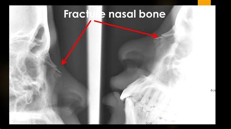 Nasal Bone X Ray Store Deals | radio.egerton.ac.ke