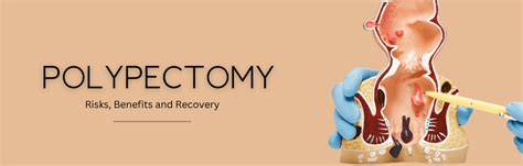 Understanding a Polypectomy: Risks, Benefits, and Recovery - GiDoc CPT