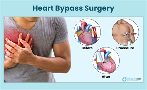 Heart Bypass Surgery (CABG) - Video, Full Form, Procedure