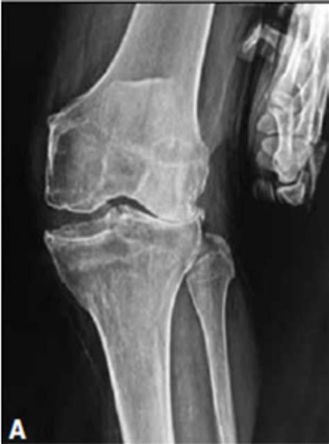 Use of External Approach for Severe Genu Valgo Knee Arthroplasty