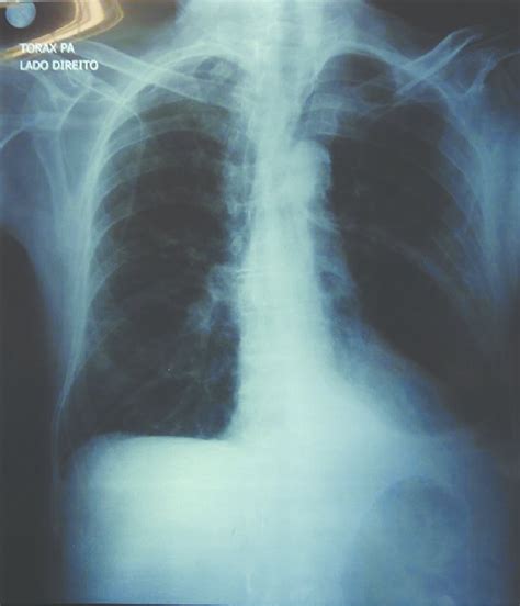 Chest X-ray showing a mild bilateral parahilar infiltrate. | Download Scientific Diagram