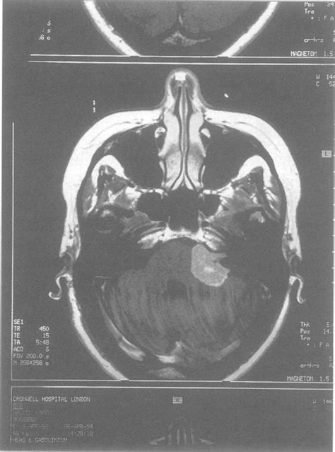 Brain MRI showing tumour in the left cerebellopontine angle. | Download Scientific Diagram