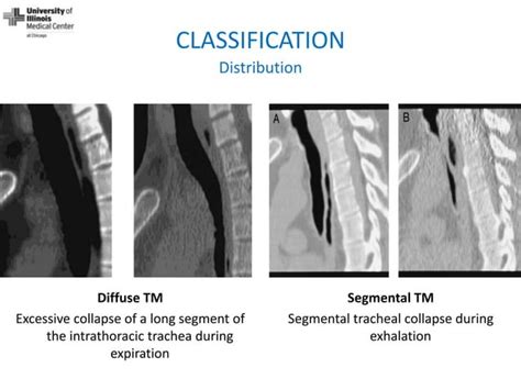 Dynamic Central Airway Obstruction: Tracheomalacia, Tracheobronchomalacia, And Excessive Dynamic ...