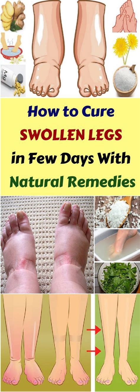 How To Cure Swollen Legs In Few Days & Natural Remedy | Swollen legs, Foot remedies, Swollen ...