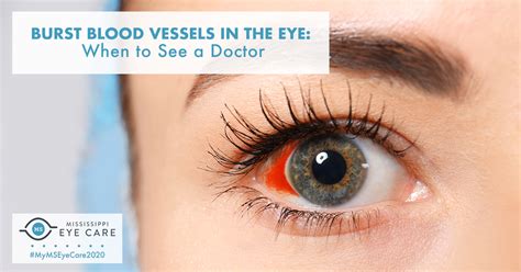 Burst Blood Vessels in the Eye: When to See a Doctor - Mississippi Eye Care