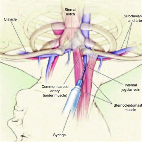 Placement of a central venous catheter in the right internal jugular ...