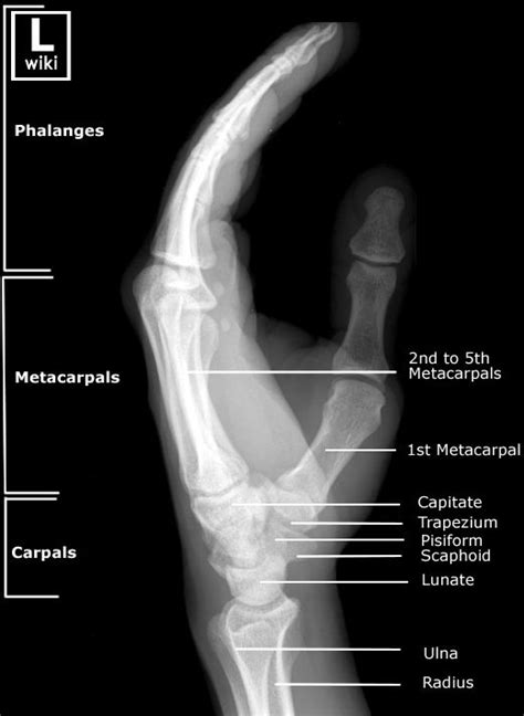 Hand Radiographic Anatomy - wikiRadiography | Diagnostic imaging, Medical anatomy, Medical knowledge