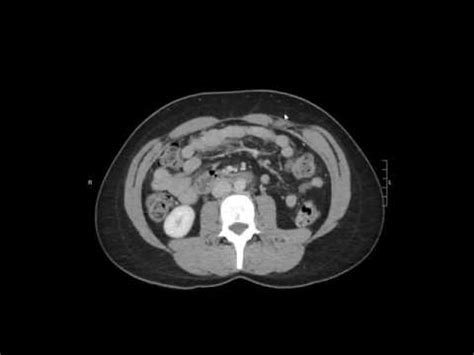 Normal CT Abdomen/Pelvis - YouTube