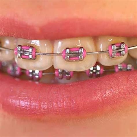 Metal braces | 32 Dental Studio