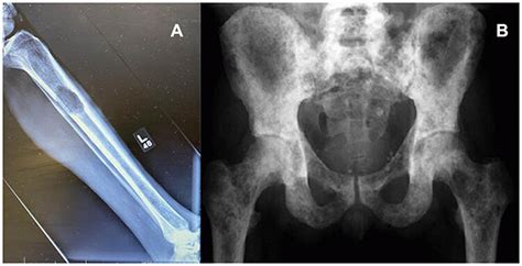 Anteroposterior radiographs showing: (A) Lytic bone lesion in tibial... | Download Scientific ...