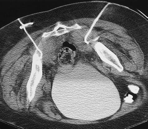 Ir Drainage Of Abscess