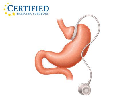 LAP-BAND® System | Certified Bariatric Surgeons