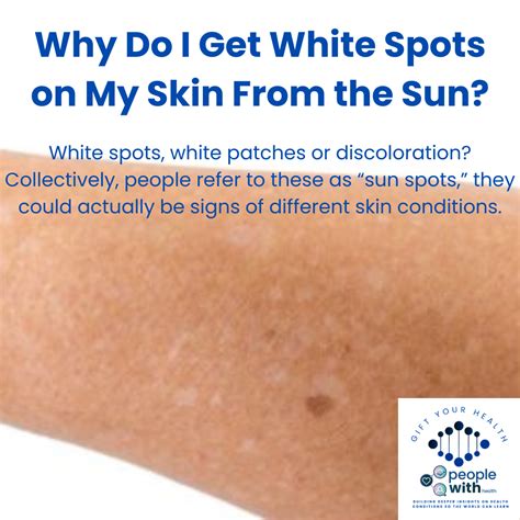 PeopleWith | News | Why Do I Get White Spots on My Skin From the Sun?