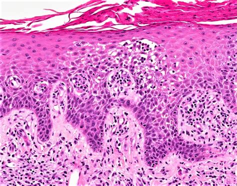 Eczematous Dermatitis Histopathology