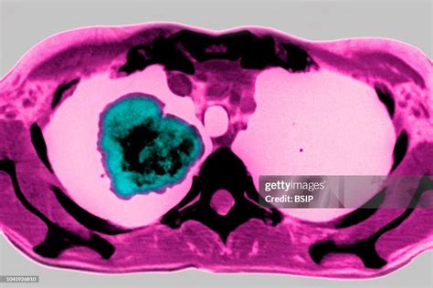 Smoking-related lung cancer, seen on a radial section chest CT scan. News Photo - Getty Images