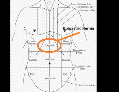 What is Epigastric Hernia | Swami Dayanand Naturopathy Hospital