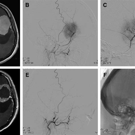 A 41-year-old woman with sphenoid ridge meningioma: (A)... | Download Scientific Diagram