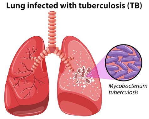 Tuberculosis Vectors, Photos and PSD files | Free Download