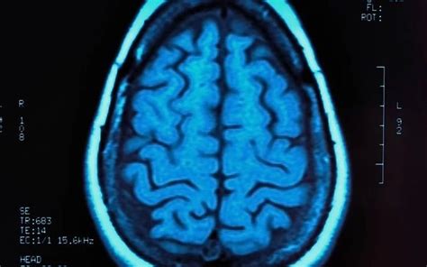 PET Scan Radiotracer May Help Identify Early Signs of MS... | Human ...