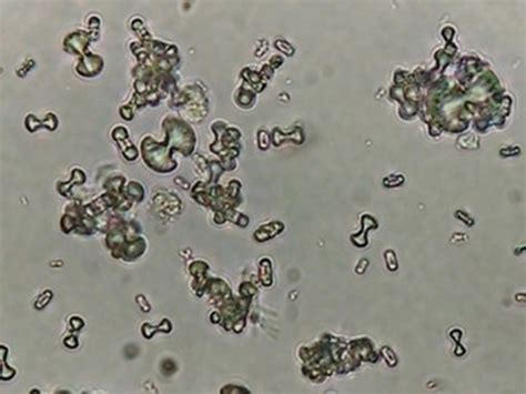 Calcium Oxalate Dihydrate Crystals In Urine