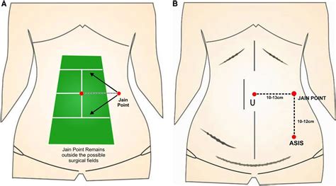 Frontiers | Jain point laparoscopic entry in contraindications of Palmers point