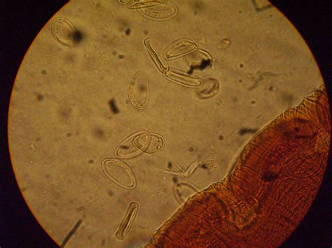 Entoebius vermicularis - DocCheck