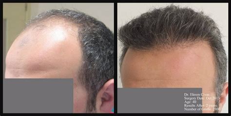 Civas Hair Transplant Turkey Before After Photos