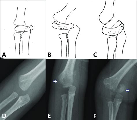 The modified version of the Delee's classification. Group A ...