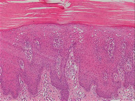 A study of the histopathology of palmo-plantar psoriasis and hyperkeratotic palmo-plantar ...